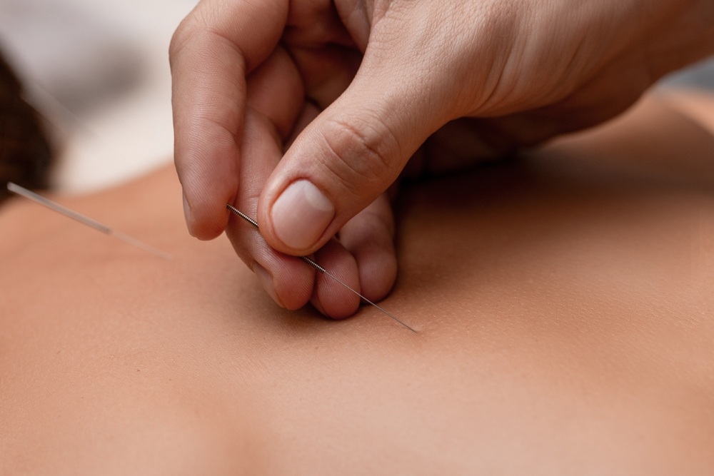 What Conditions Can Acupuncture Effectively Treat Beyond Pain Relief?