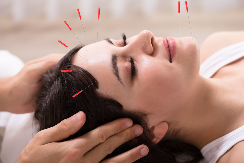 Is Acupuncture an Effective Treatment for Stress and Anxiety?